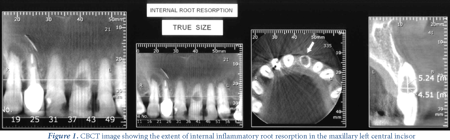 Internal root. Апексогенез и апексификация. CBCT scan.